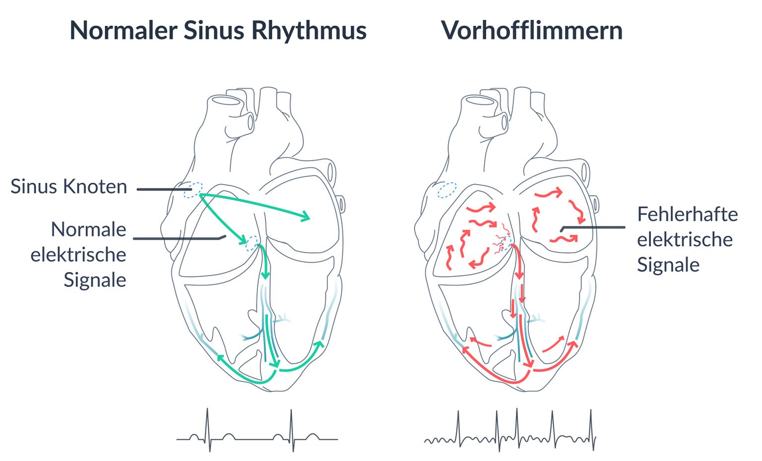 App Vorhofflimmern die häufigste Form der Herzrhythmusstörungen Preventicus Heartbeats